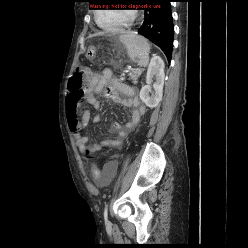 Abdominal wall hematoma (Radiopaedia 9427-10112 Sagittal C+ portal venous phase 31).jpg