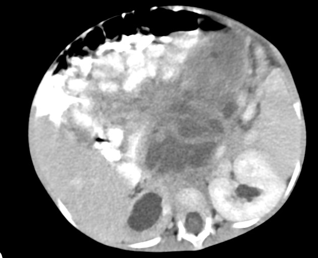 Abdominopelvic rhabdomyosarcoma (Radiopaedia 78356-90984 Axial C+ portal venous phase 71).jpg