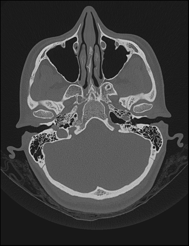 Aberrant right internal carotid artery (Radiopaedia 65191-74198 Axial non-contrast 33).jpg