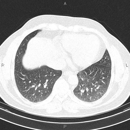 File:Aberrant right subclavian artery (Radiopaedia 87093-103354 Axial lung window 80).jpg