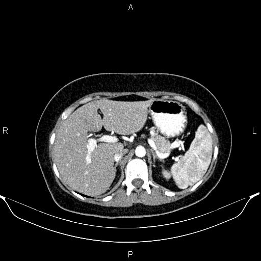 Aberrant right subclavian artery (Radiopaedia 87334-103629 Axial C+ arterial phase 69).jpg