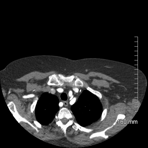 Aberrant right subclavian artery stenosis (Radiopaedia 52656-58670 Axial C+ arterial phase 15).jpg