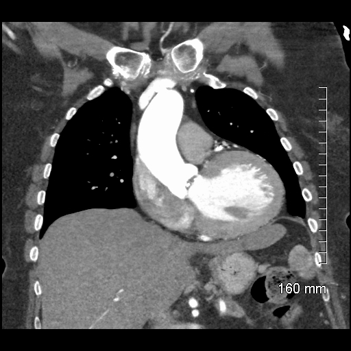 Aberrant right subclavian artery stenosis (Radiopaedia 52656-58670 B 37).jpg