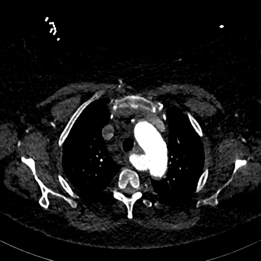 Aberrant right subclavian artery with Kommerell diverticulum (Radiopaedia 47982-52769 Axial C+ arterial phase 23).png