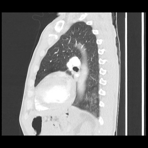 Accessory left horizontal fissure with lingular pneumonia (Radiopaedia 53763-59843 Sagittal lung window 44).jpg