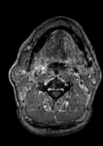 Accessory middle cerebral artery (Radiopaedia 73114-83828 Axial T1 C+ 295).jpg