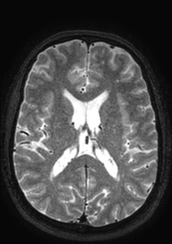 Accessory middle cerebral artery (Radiopaedia 73114-83828 Axial T2 43).jpg