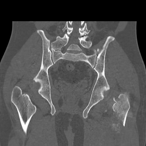 Acetabular and ilial fractures (Radiopaedia 59084-66378 Coronal bone window 35).jpg