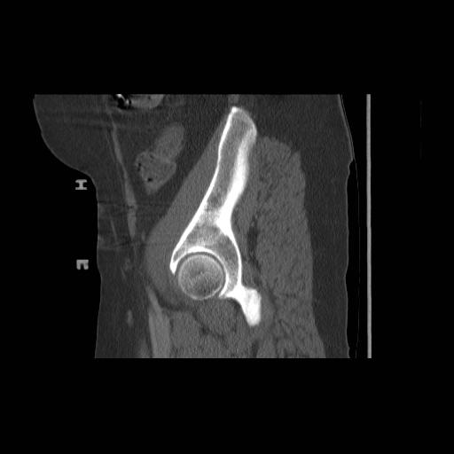 File:Acetabular fracture (Radiopaedia 13193-13212 Sagittal bone window 23).jpg