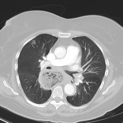 File:Achalasia (Radiopaedia 47147-51685 Axial lung window 23).png