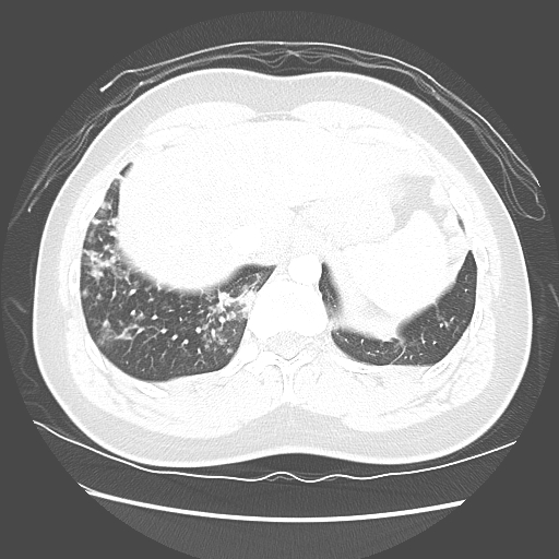 File:Achalasia (Radiopaedia 52507-58417 Axial lung window 56).jpg