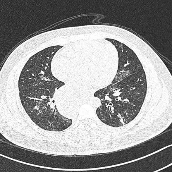 Achalasia with aspiration (Radiopaedia 55413-61845 Axial lung window 45).jpg