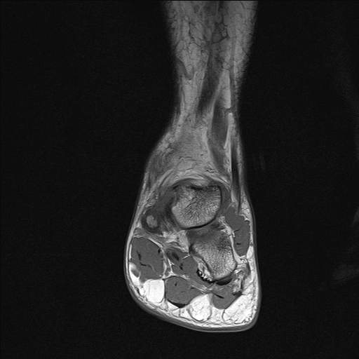 File:Achilles tendon tear (Radiopaedia 77615-89819 Coronal T1 12).jpg