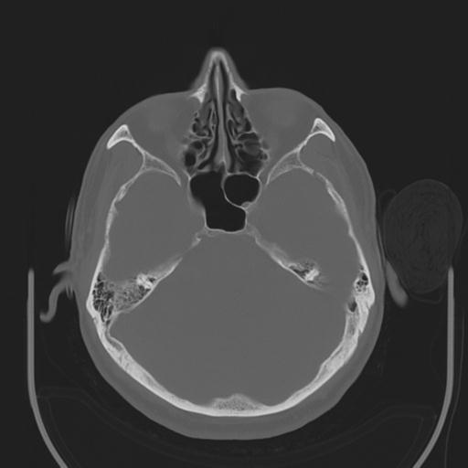 File:Acoustic schwannoma (Radiopaedia 29488-29982 AXIAL BONE THICK non-contrast 15).jpg