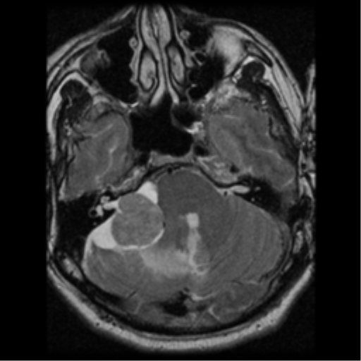 File:Acoustic schwannoma (Radiopaedia 39170-41387 Axial T2 9).png