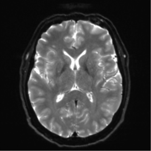 File:Acoustic schwannoma (Radiopaedia 50846-56358 Axial DWI 16).png