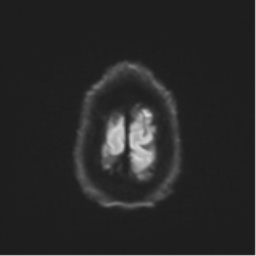 Acoustic schwannoma (Radiopaedia 55729-62281 E 54).png