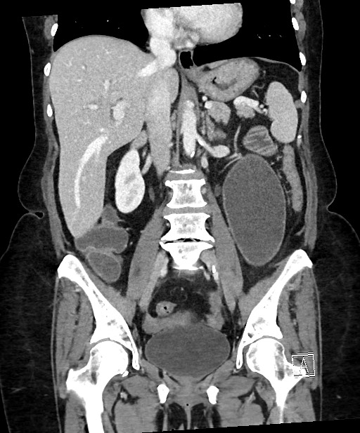 Active Crohn disease (Radiopaedia 59394-66750 Coronal C+ portal venous phase 40).jpg