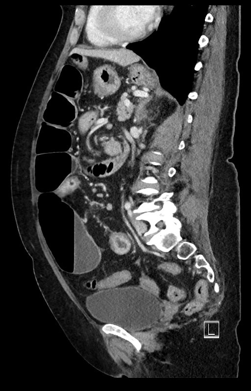 Active Crohn disease (Radiopaedia 59394-66750 Sagittal C+ portal venous phase 24).jpg