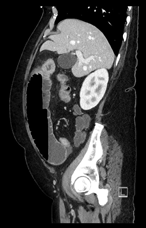 Active Crohn disease (Radiopaedia 59394-66750 Sagittal C+ portal venous phase 41).jpg