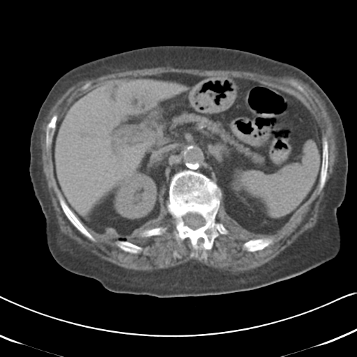 Active bleeding from duodenal ulcer with embolization (Radiopaedia 34216-35481 Axial non-contrast 22).png