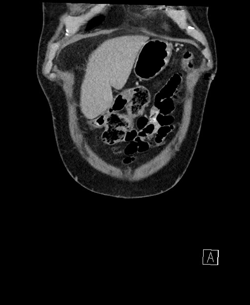 Active lower gastrointestinal bleeding - diverticular (Radiopaedia 61203-69106 Coronal C+ portal venous phase 18).jpg