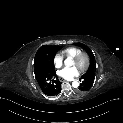 File:Active renal extravasation with large subcapsular and retroperitoneal hemorrhage (Radiopaedia 60975-68796 Axial C+ arterial phase 3).jpg