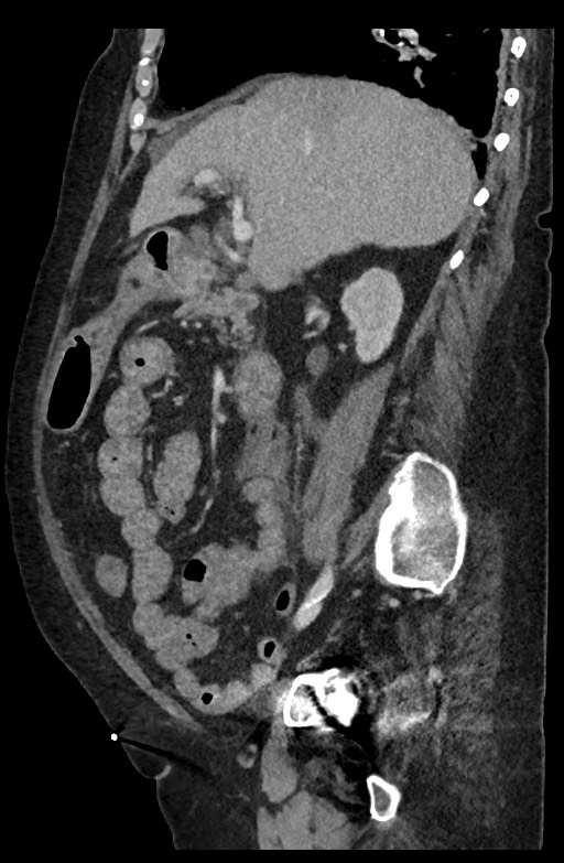 Active renal extravasation with large subcapsular and retroperitoneal hemorrhage (Radiopaedia 60975-68796 Sagittal C+ portal venous phase 142).jpg