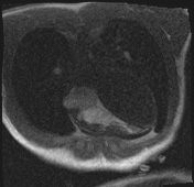 File:Active right ventricular cardiac sarcoidosis (Radiopaedia 55596-62100 Axial Dynamic perfusion scan MOCO 29).jpg