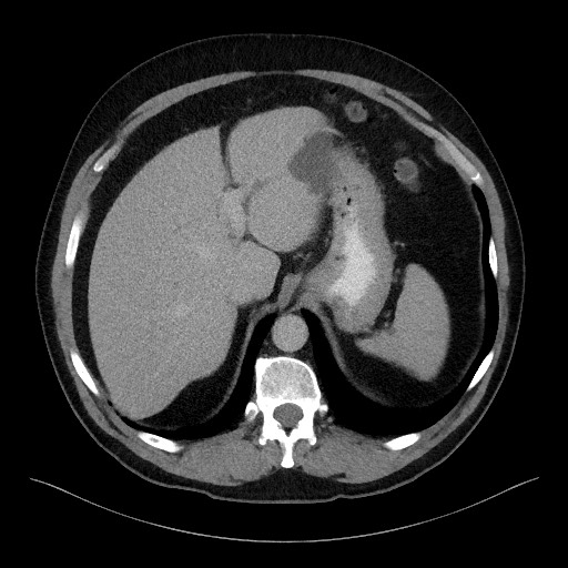 File:Acute-on-chronic pancreatitis (Radiopaedia 67286-76656 Axial C+ portal venous phase 17).jpg