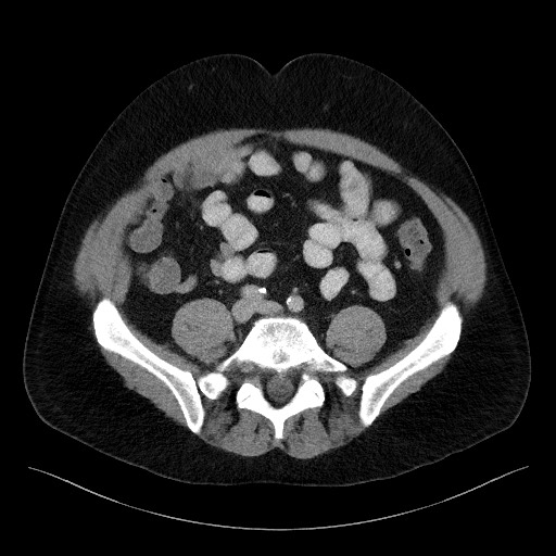 Acute-on-chronic pancreatitis (Radiopaedia 67286-76656 Axial C+ portal venous phase 54).jpg