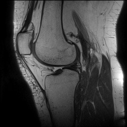 File:Acute-on-chronic transient lateral patellar dislocation with trochlear dysplasia (Radiopaedia 84099-99349 Sagittal PD 93).jpg