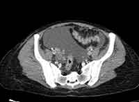 Acute Budd-Chiari syndrome (Radiopaedia 60858-68638 A 239).jpg