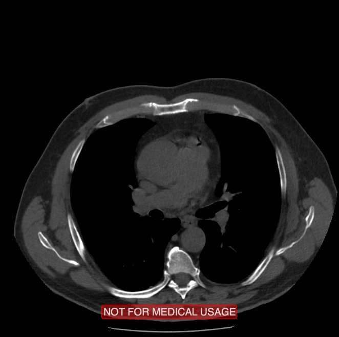 Acute aortic dissection - Stanford type A (Radiopaedia 40661-43285 Axial non-contrast 24).jpg