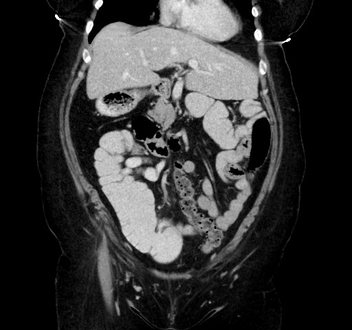 Acute appendicitis, heterotaxy syndrome (Radiopaedia 66884-76202 Coronal C+ portal venous phase 39).jpg