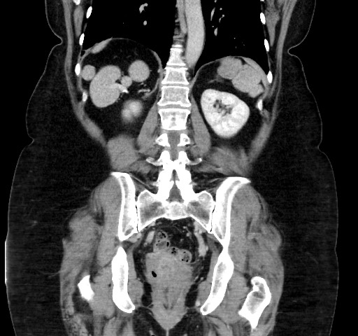 Acute appendicitis, heterotaxy syndrome (Radiopaedia 66884-76202 Coronal C+ portal venous phase 87).jpg