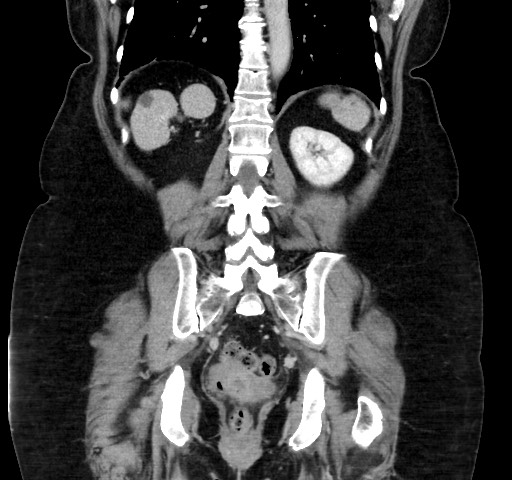 Acute appendicitis, heterotaxy syndrome (Radiopaedia 66884-76202 Coronal C+ portal venous phase 90).jpg