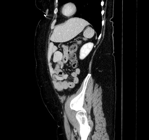 Acute appendicitis, heterotaxy syndrome (Radiopaedia 66884-76202 Sagittal C+ portal venous phase 102).jpg