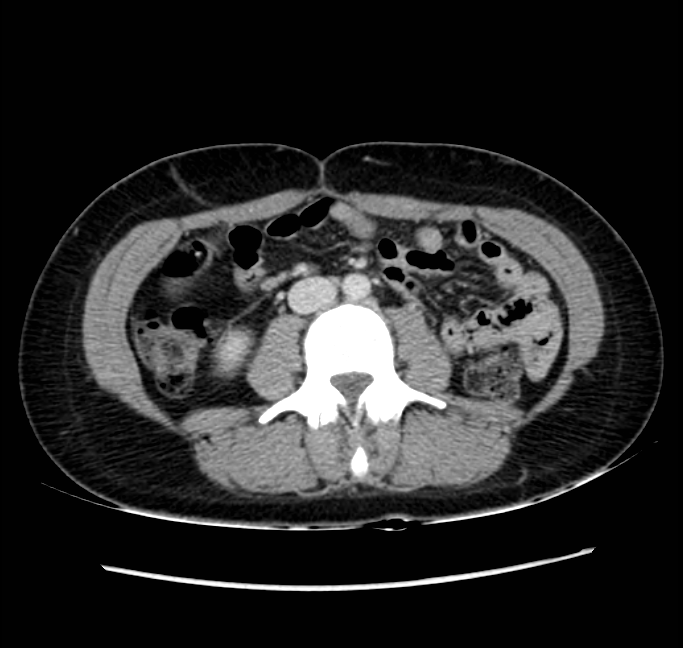 Acute appendicitis (Radiopaedia 22892-22918 Axial C+ portal venous phase 44).png