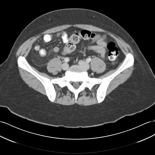 File:Acute appendicitis (Radiopaedia 30297-30934 Axial C+ portal venous phase 57).jpg
