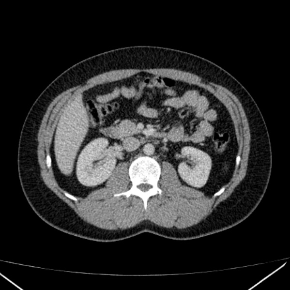 Acute appendicitis (Radiopaedia 38255-40270 Axial C+ portal venous phase 43).jpg
