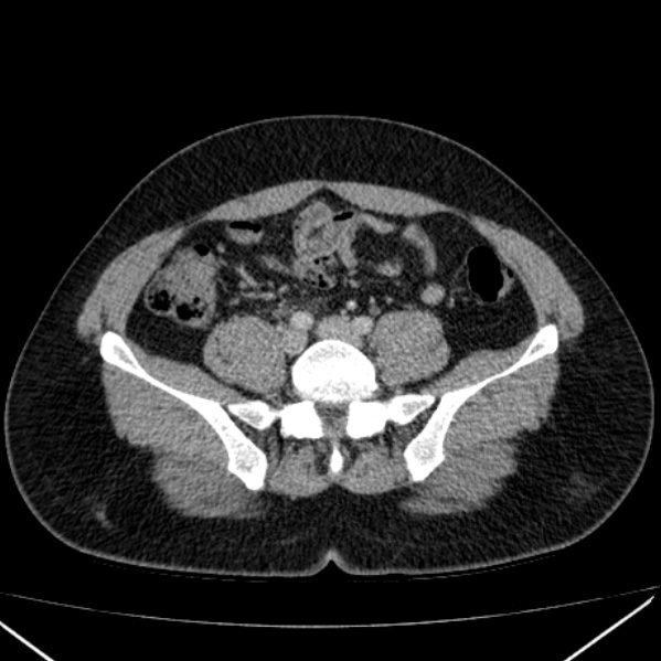Acute appendicitis (Radiopaedia 38255-40270 Axial C+ portal venous phase 74).jpg