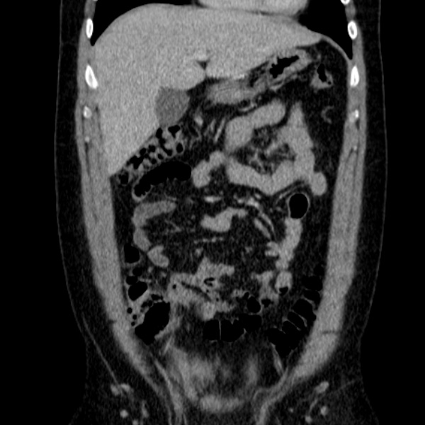 File:Acute appendicitis (Radiopaedia 38255-40270 Coronal C+ portal venous phase 28).jpg