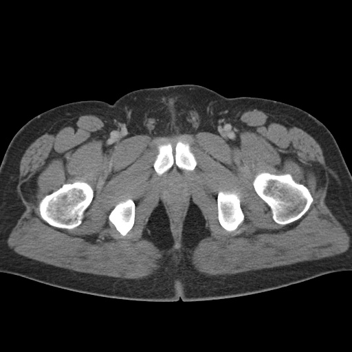 Acute appendicitis (Radiopaedia 48511-53463 Axial C+ portal venous phase 105).jpg