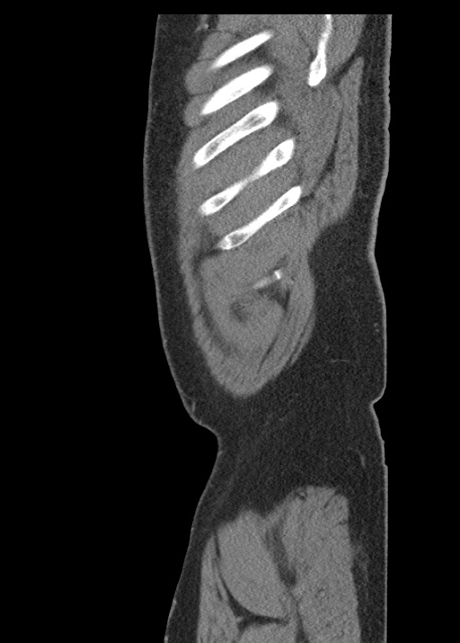 Acute appendicitis (Radiopaedia 48511-53463 Sagittal C+ portal venous phase 19).jpg
