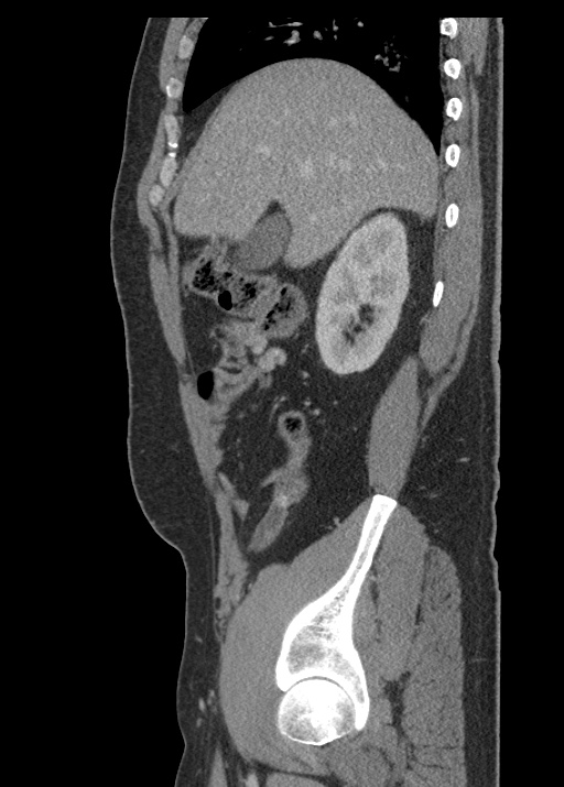 Acute appendicitis (Radiopaedia 48511-53463 Sagittal C+ portal venous phase 44).jpg