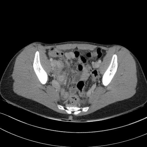 Acute appendicitis (Radiopaedia 62608-70901 Axial C+ portal venous phase 35).jpg
