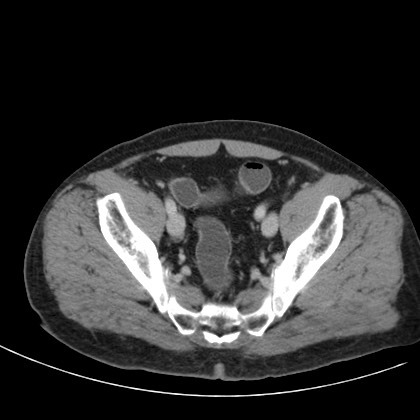 File:Acute appendicitis (Radiopaedia 66513-75790 Axial C+ portal venous phase 76).jpg