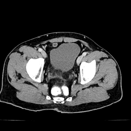 Acute appendicitis (Radiopaedia 77016-88960 Axial C+ portal venous phase 128).jpg