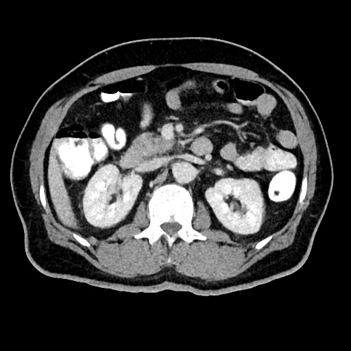 Acute appendicitis (Radiopaedia 77016-88960 Axial C+ portal venous phase 57).jpg